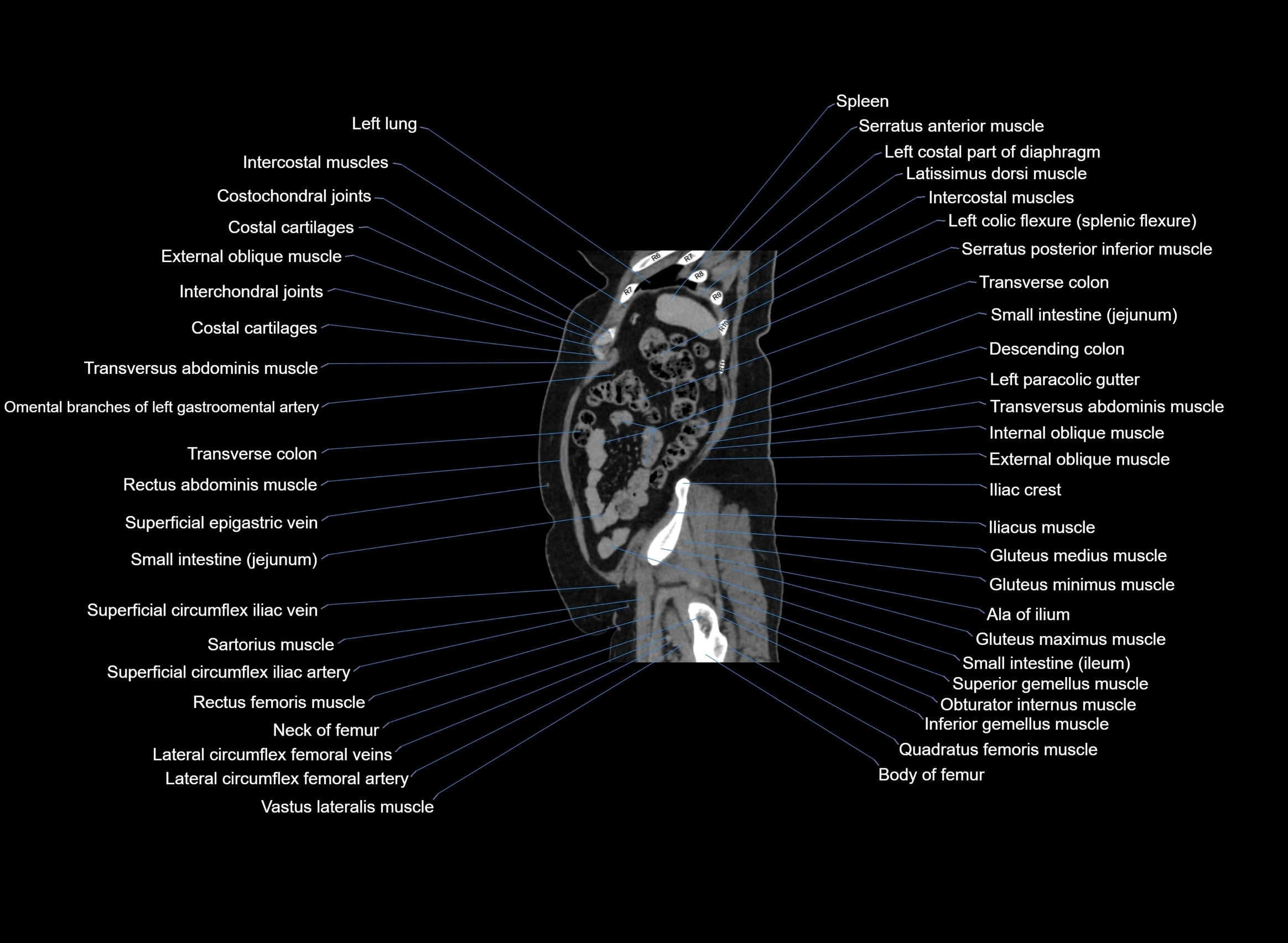 CT Abdomen sagittal cross sectional anatomy labelled radiology image -00021.webp
